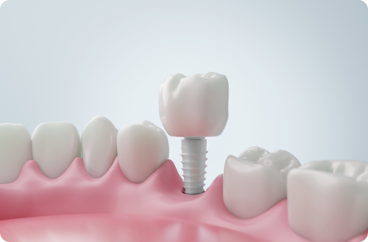 implant ceramique tramontane Dentiste à Narbonne, Cabinet dentaire La Tramontane