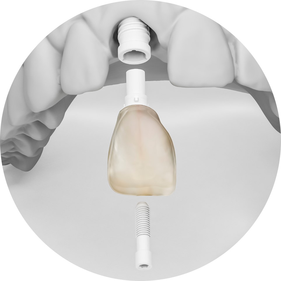 implant ceramique narbonne dentiste Dentiste à Narbonne, Cabinet dentaire La Tramontane