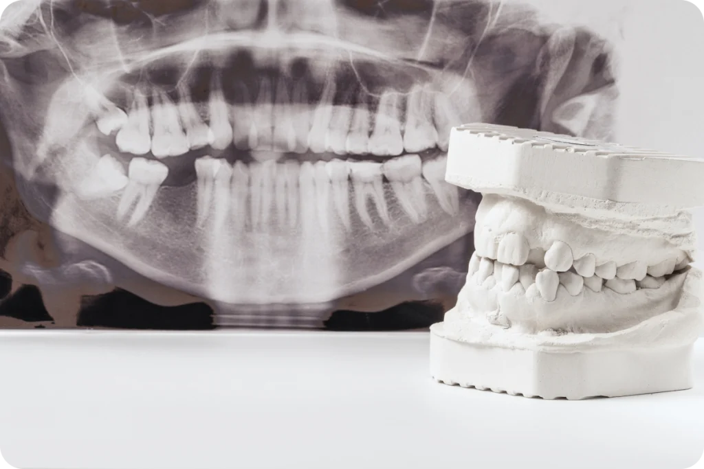 pose implant dentaire narbonne mastication Dentiste à Narbonne, Cabinet dentaire La Tramontane