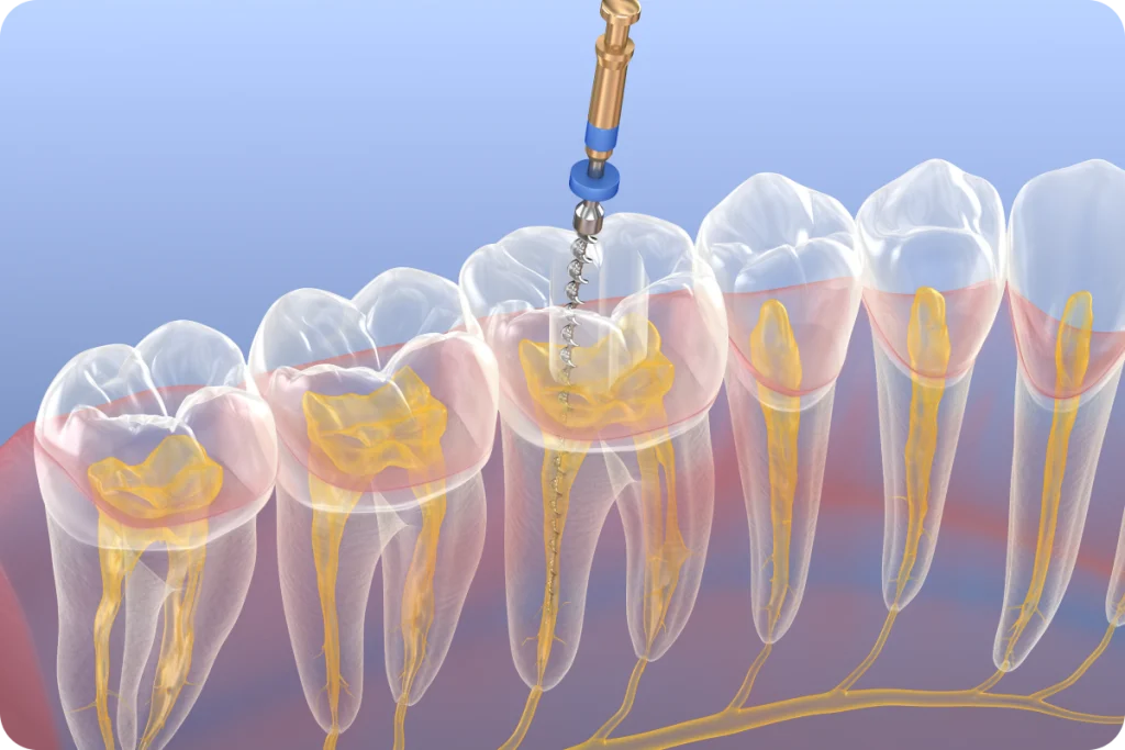 traitement endodontique narbonne dentiste Dentiste à Narbonne, Cabinet dentaire La Tramontane