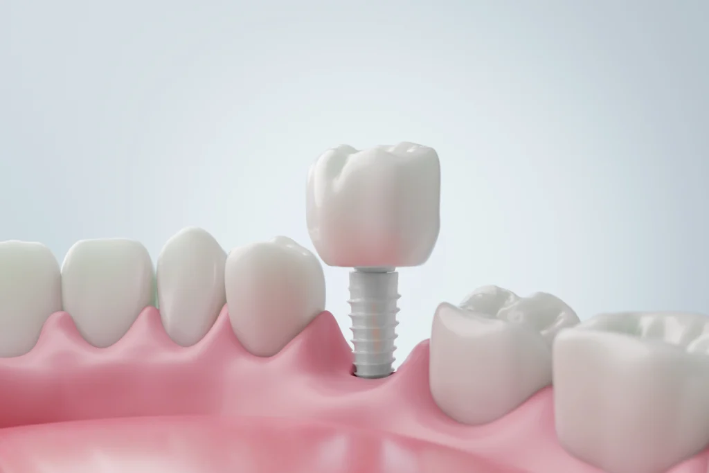 implant dentaire ceramique narbonne Dentiste à Narbonne | Cabinet dentaire La Tramontane