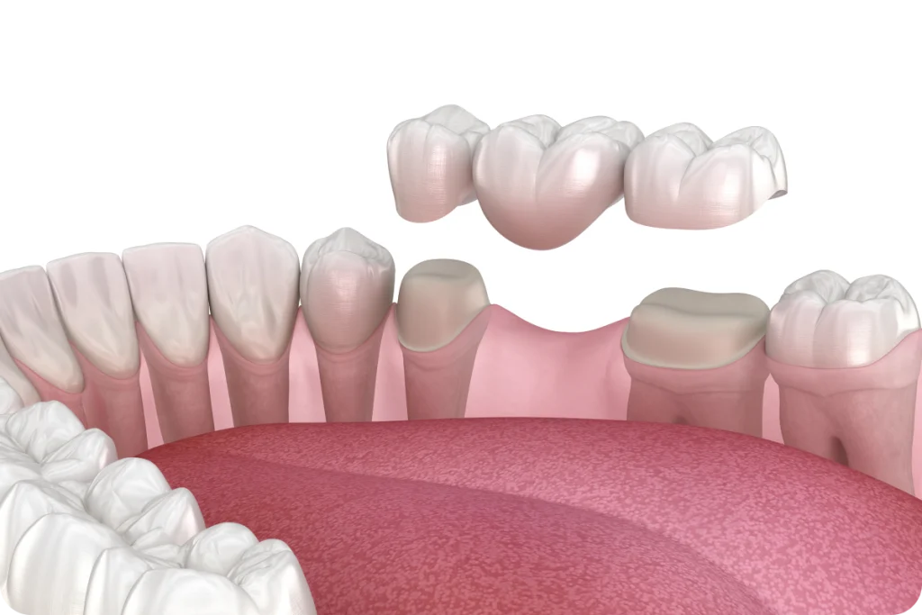 narbonne couronne implant dentaire narbonne couronne implant dentaire Dentiste à Narbonne | Cabinet dentaire La Tramontane